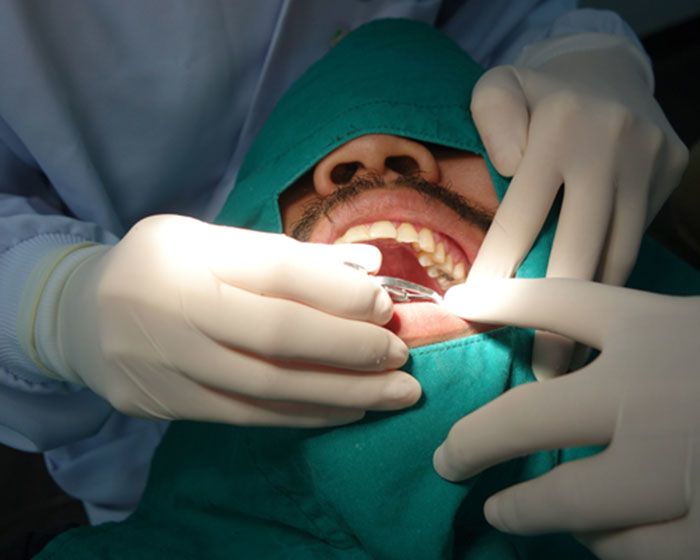 Root Canal Treatment